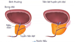 Phì đại tuyến tiền liệt: Chế độ ăn uống có đóng vai trò gì không?