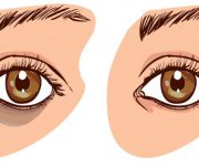 Tại sao mắt bị thâm quầng? cách chữa nhanh nhất
