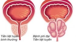 Phì đại tuyến tiền liệt nên ăn gì và kiêng ăn gì?